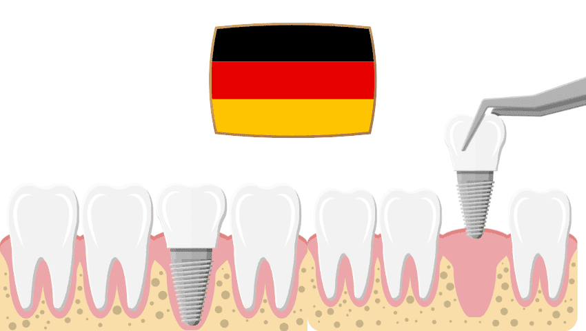 Dental implants in Germany